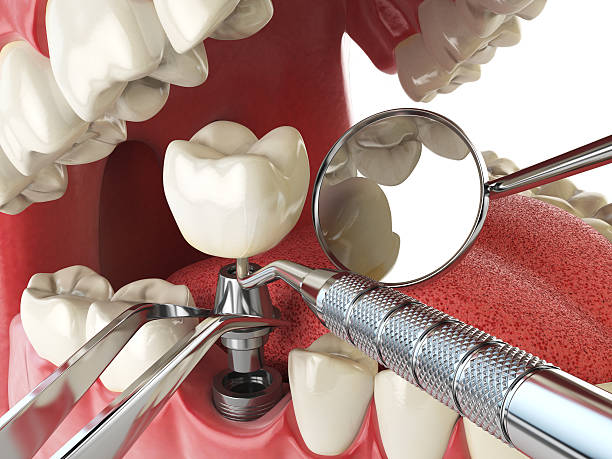 Best Emergency Dental Care for Abscessed Tooth in Rouse, CA