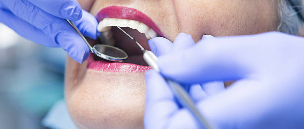 Best Emergency Dentist for Lost Fillings or Crowns in Rouse, CA